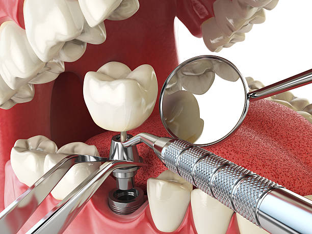 Best Emergency Tooth Extraction in Balfour, NC